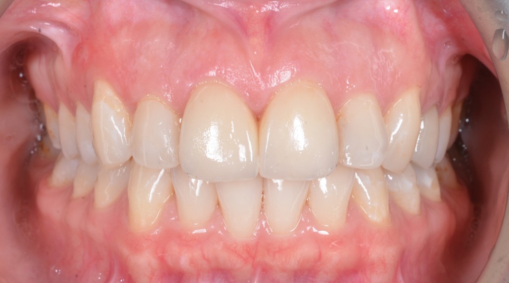 אחרי - תוצאה אסתטית של שיניים קדמיות וחניכיים בריאות (טכנאי - רוני נחום, טופלאב)